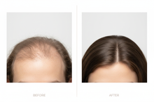 Charger l'image dans la galerie, a comparison of two scalps , one showing a little bit of baldness and the other notorios more hair, same scalp
